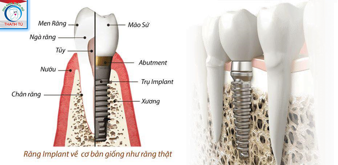 cấy ghép implant