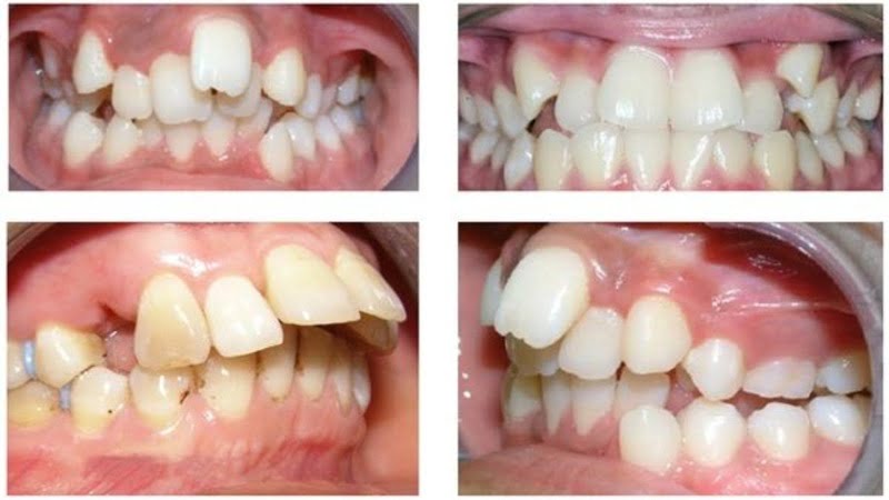 Những ảnh hưởng của răng hô tới sức khỏe Ảnh hưởng chức năng nhai: Răng hô gây sai lệch khớp cắn. Vì vậy, những người bị hô thường khó cắn khớp được hai hàm. Vì vậy, những người bị hô sẽ gặp rất nhiều khó khăn trong việc xe và nghiền nhỏ thức ăn. Khó vệ sinh: Khớp cắn bị sai lệch dẫn tới tình trạng các răng không mọc đều. Do đó, những khoảng trống giữa các răng là điều không tránh khỏi. Vì vậy, khi vệ sinh răng hô, bạn sẽ cần phải cẩn thận hơn rất nhiều. Gây trở ngại trong việc phát âm: Do phần hàm không khớp, dẫn tới việc những người bị hô gặp rất nhiều khó khăn trong việc phát âm tròn vành, rõ chữ. Mất tự tin, ngại giao tiếp là điều bạn dễ thấy ở những người gặp vấn đề về răng. Những người bị hô cũng không nằm ngoài ngoại lệ.